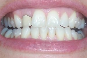 teeth nov 09 set 23 teeth nov 09 set 23