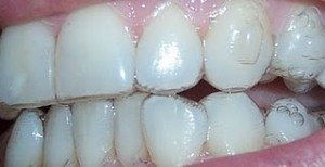 Invisalign Attachments Invisalign attachments