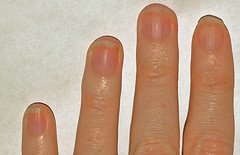 broken nails