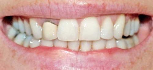 Invisalign braces nov 10