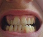 before invisalign