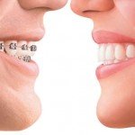 invisalign vs braces