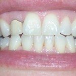 teeth after invisalign