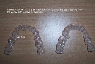 Set 11 of Invisalign braces, widening my arches - My Invisalign Blog